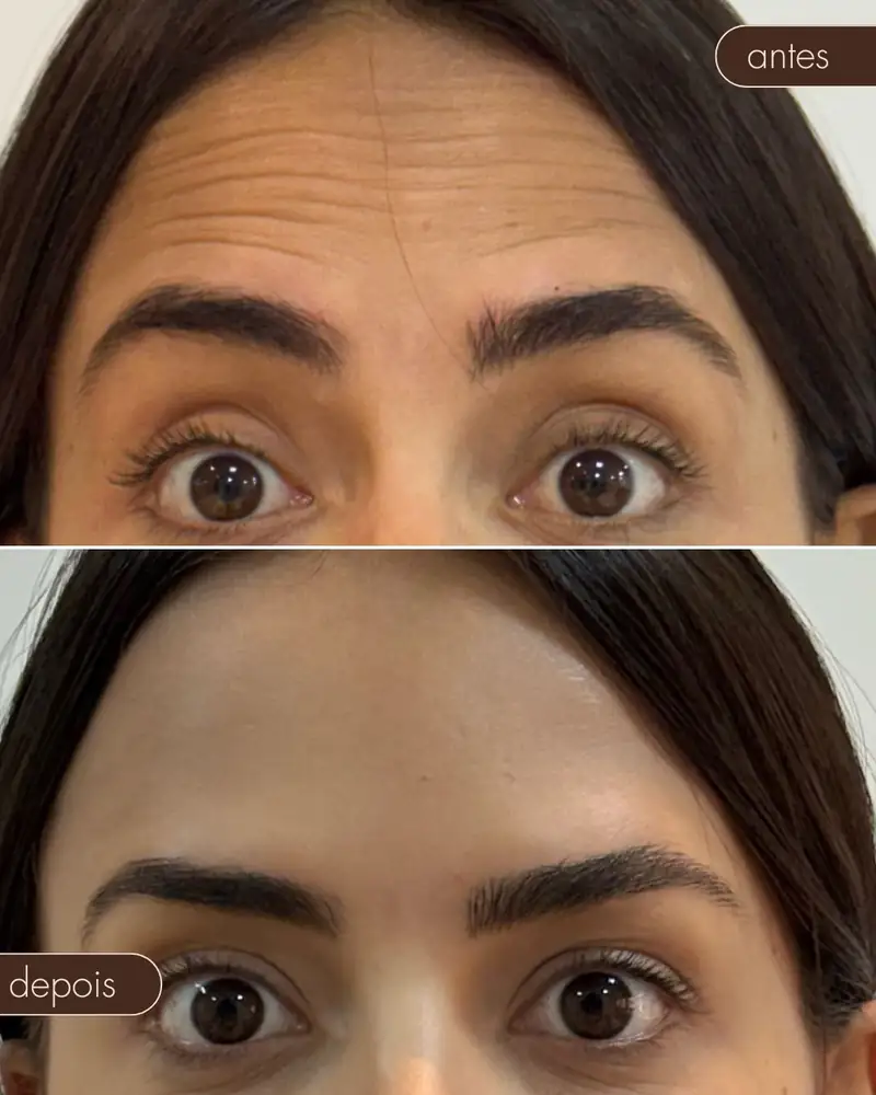 Antes e depois — Botox